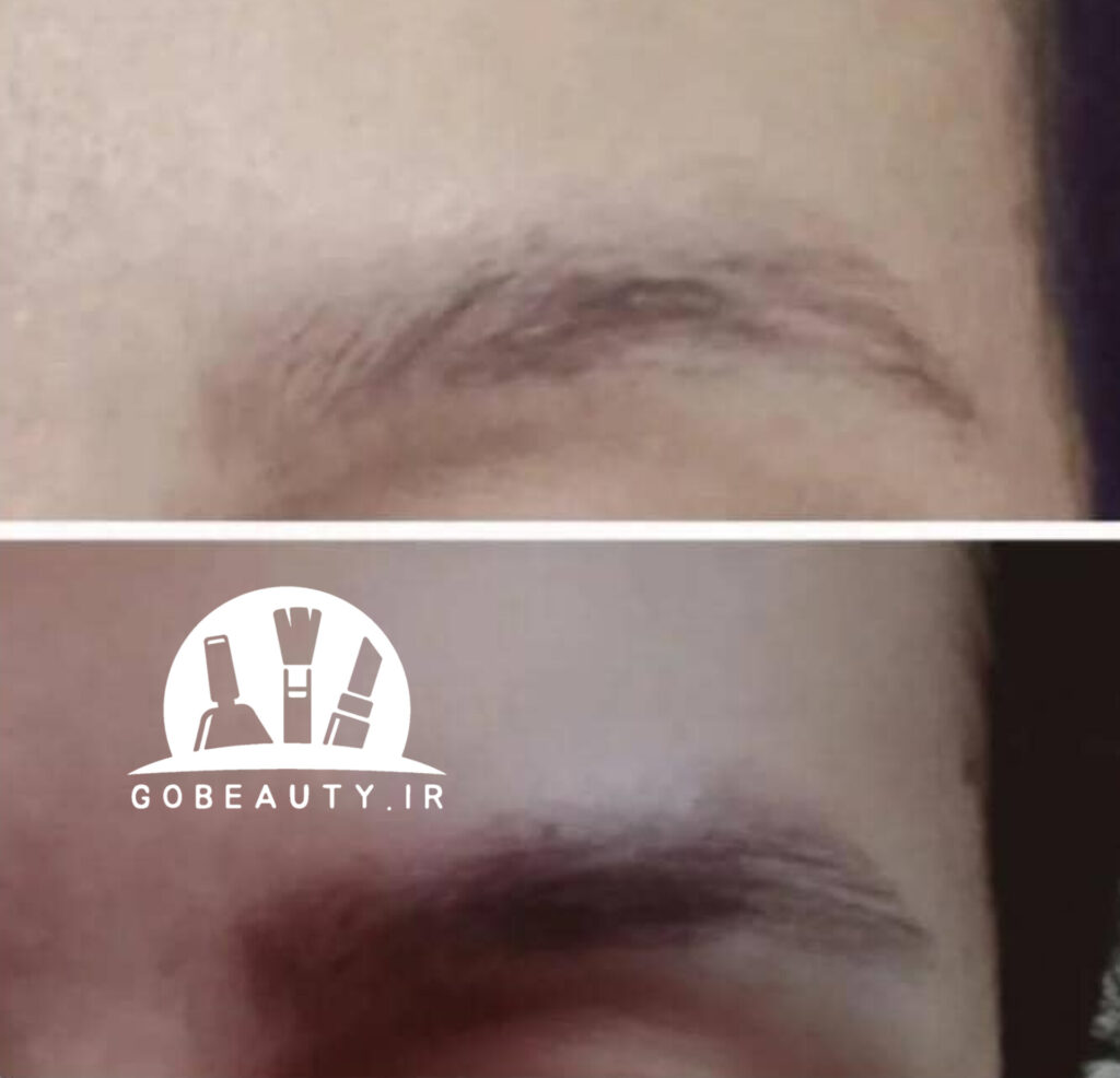 نتیجه سرم ابرو تراست و رویش مجدد ابروها