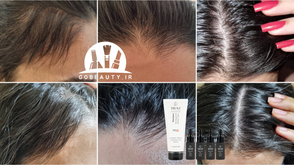 کیت تخصصی رویش مجدد مو تراست: پایان افسانه ریزش مو؟ مقایسه اثربخشی با تونیک‌های مطرح بازار و یک مزیت بی‌رقیب!